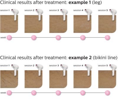 Philips SC2009/00 Lumea Prestige, IPL Epilator for Body, Face and